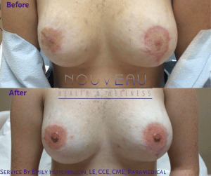 Post Surgical Revision of Areola